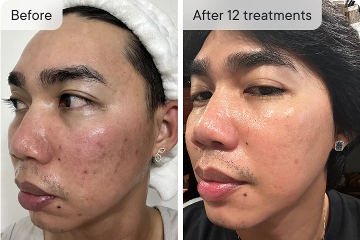 SkinVive - Microneedling System