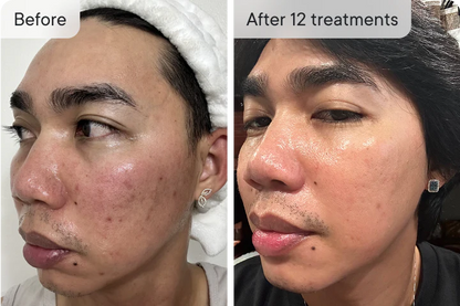 SkinVive - Microneedling System