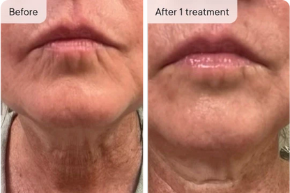SkinVive - Microneedling System