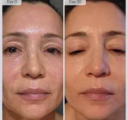 SkinVive - Microneedling System