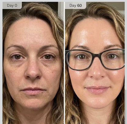 SkinVive - Microneedling System