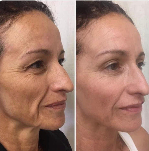 SkinVive - Microneedling System